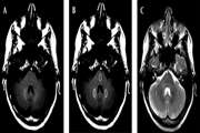 Evaluation of the effect of multiple linear gadolinium-based contrast agent exposures on the signal intensity of the dentate nucleus in multiple sclerosis patients